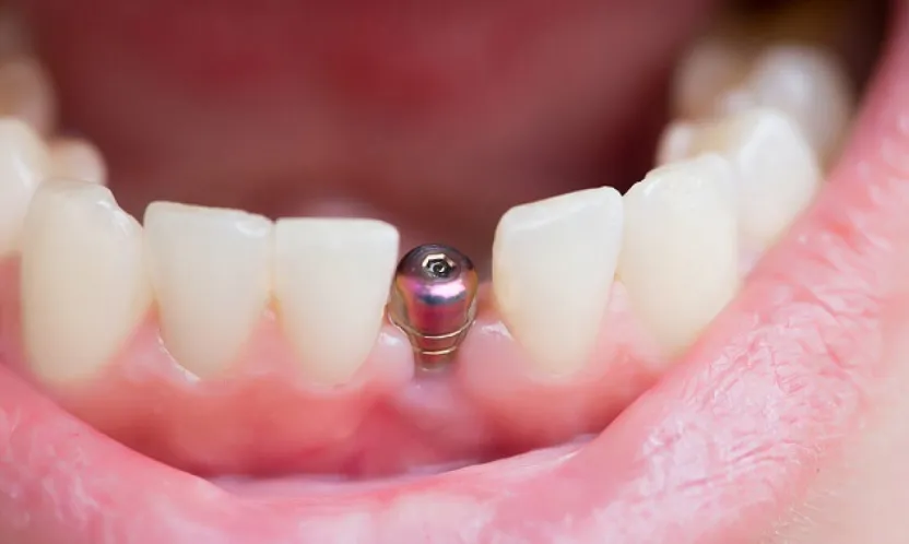 İmplant tedavisi SGK kapsamına alınacak mı?